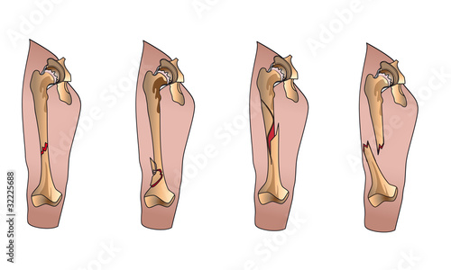 Types of fractures