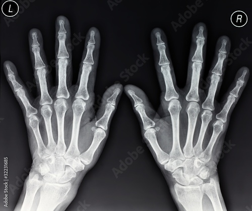 Hands X-ray