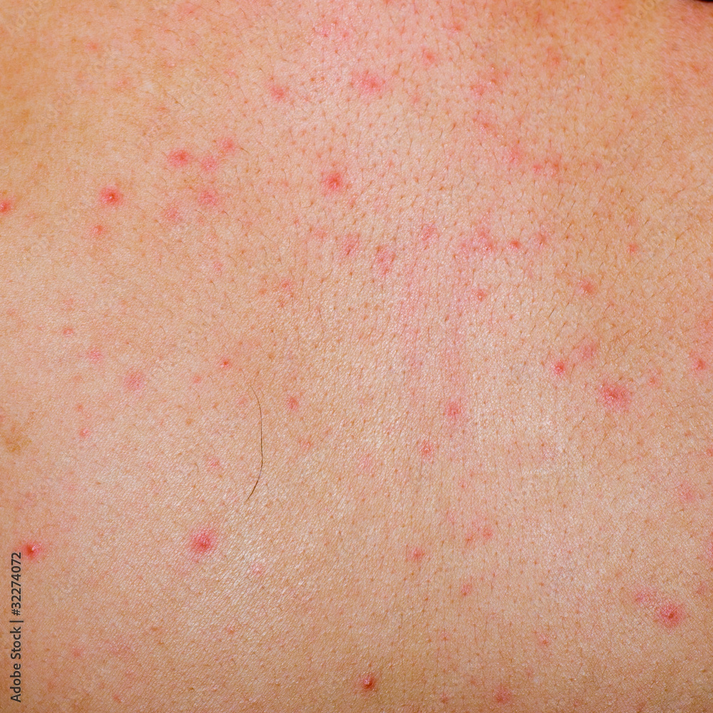 allergic rash dermatitis skin allergic rash dermatitis skin