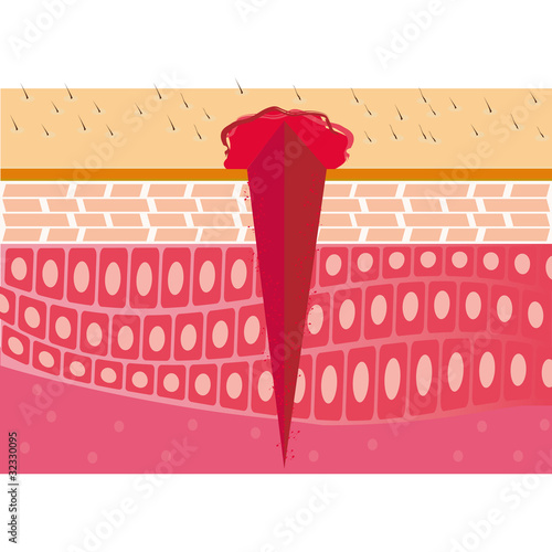 wound skin cross-section anatomy medical vector illustration