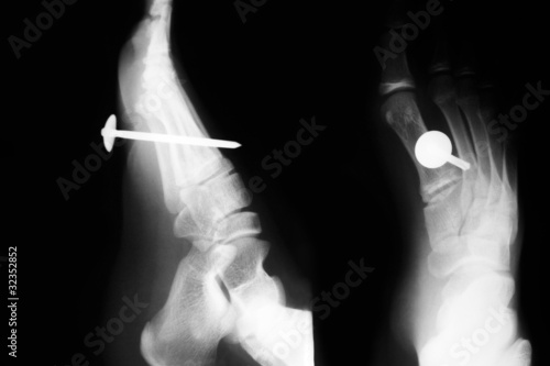 Foot X ray