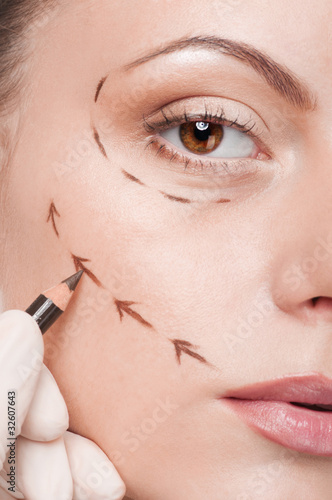 Correction lines on woman face, before surgery operetion