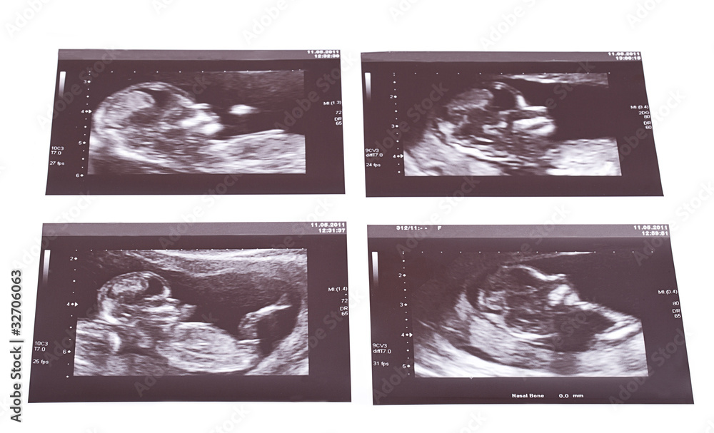 sonogram of Identical (monozygotic) twins Stock Photo Adobe Stock