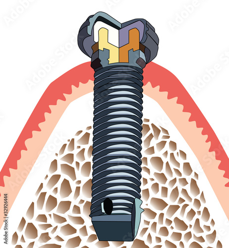 Implante dentário