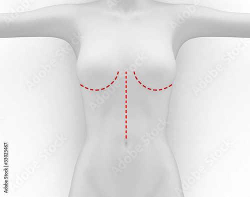 Chirurgia Plastica al seno photo