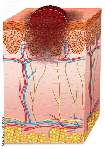 Esquema descriptivo de un Cáncer de piel tipo melanoma