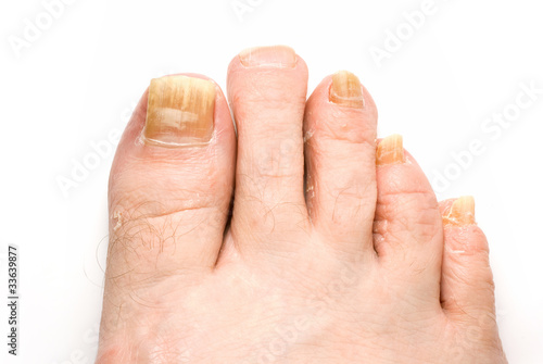 Toenail Fungus