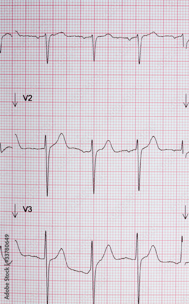 électrocardiogramme, graphique électrocardiogramme, graphique