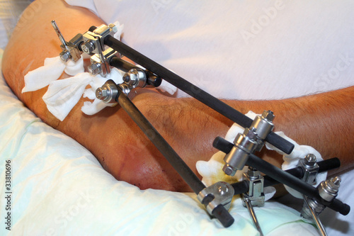 Biomechanik Chirurgie Patient mit Operation Fraktur am Arm mit Fixateur Externe