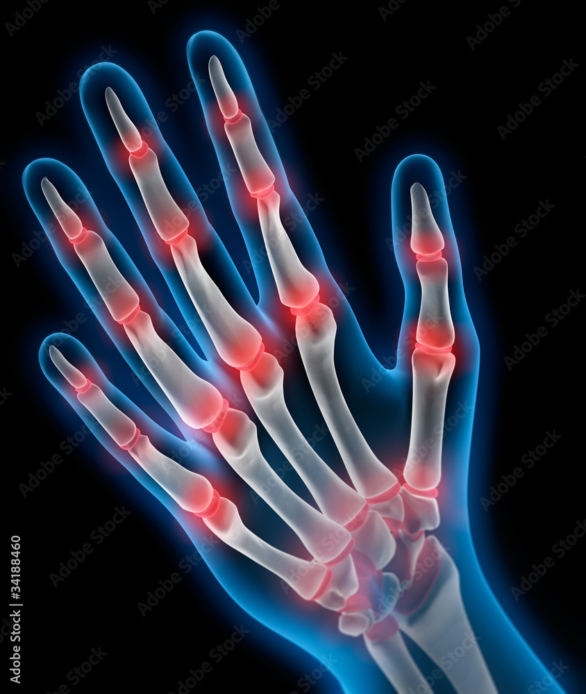 Naklejka premium Arthritis 1