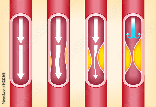 vienna human atherosclerosis