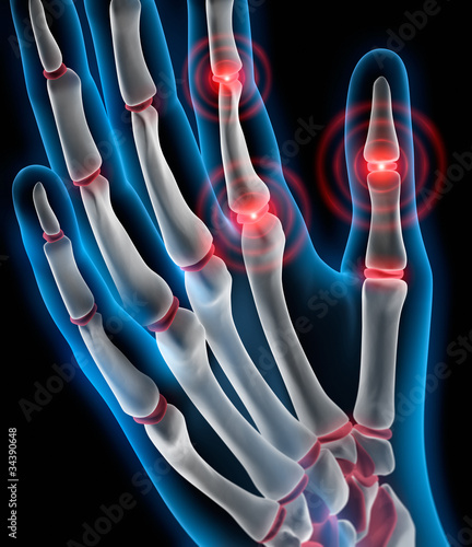 Arthritis 4 photo