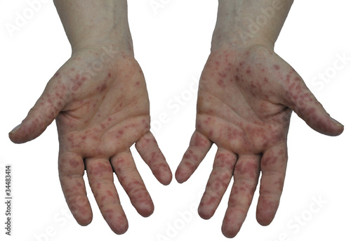 Hand, Foot and Mouth Disease 1