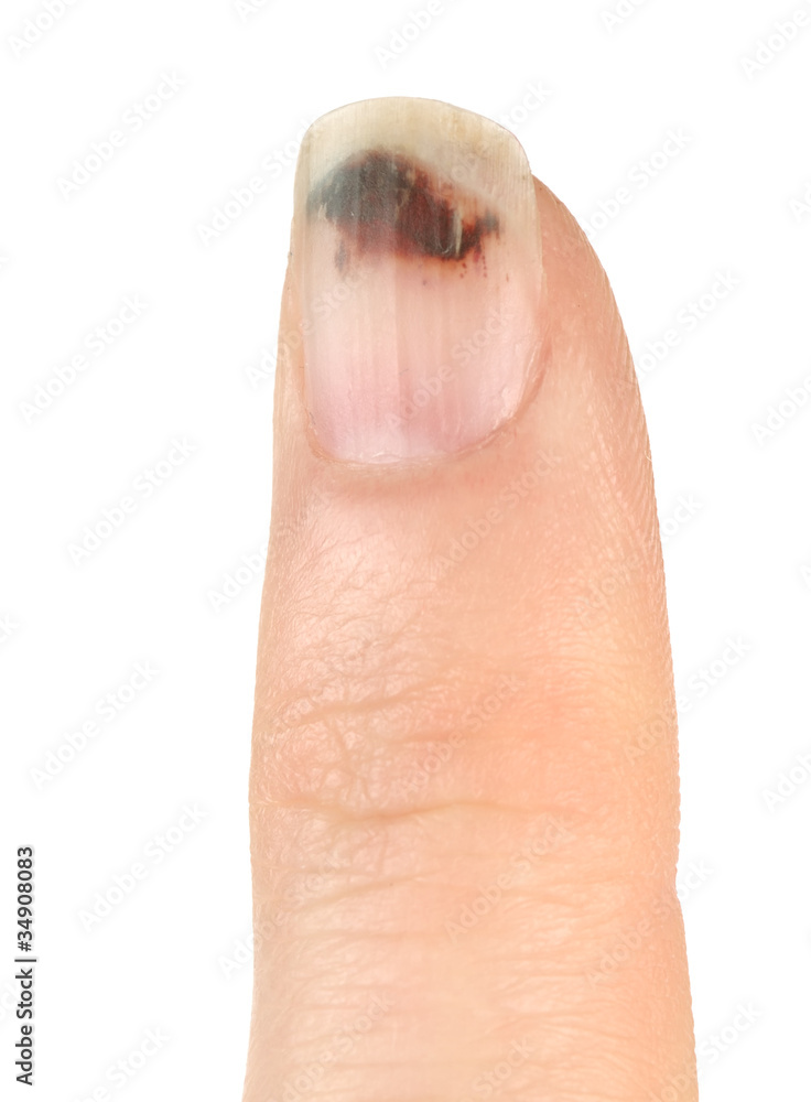 Finger with Bruised Nail (Subungual Hematoma) Stock Photo Adobe Stock