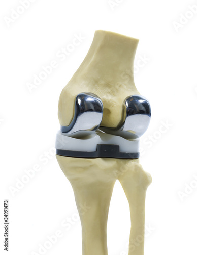 plastic model of a knee replacement