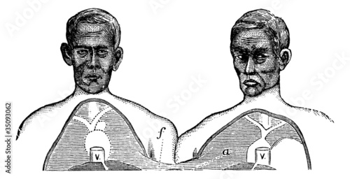 Siamese twins. V. Vena cava. f. Upper limit of the common axis,