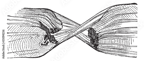 Torn Muscle Fiber, vintage engraved illustration