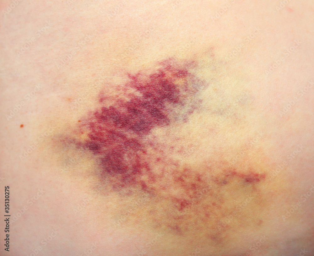 Fototapeta premium Bruise