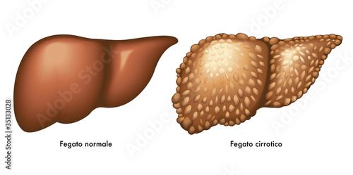 Cirrosi epatica