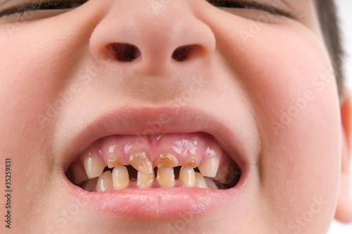 Little child with broken and decayed teeth