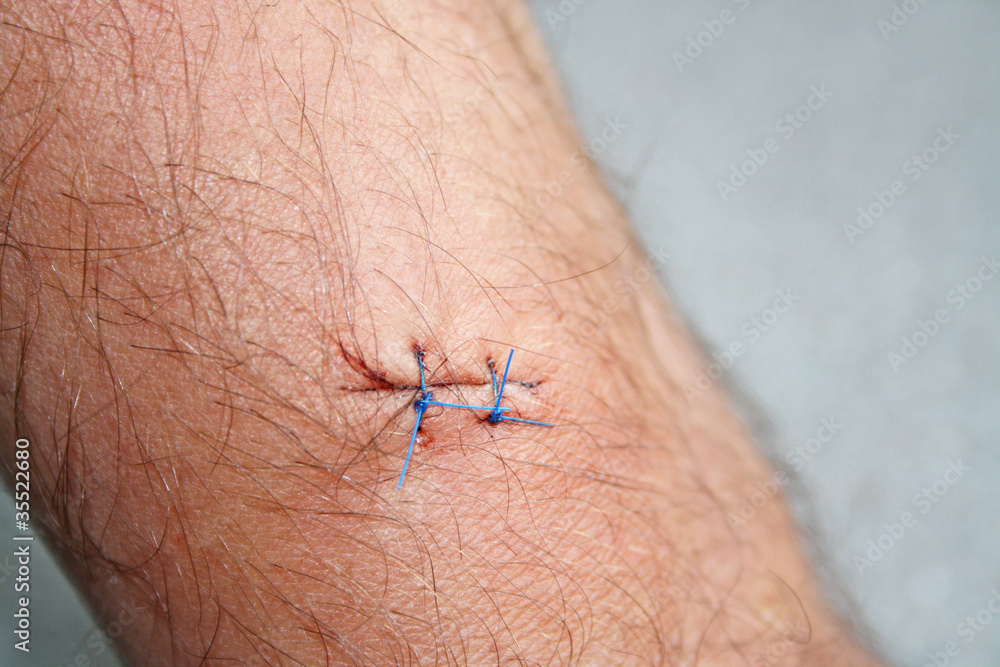 Obraz premium arm after a biopsy