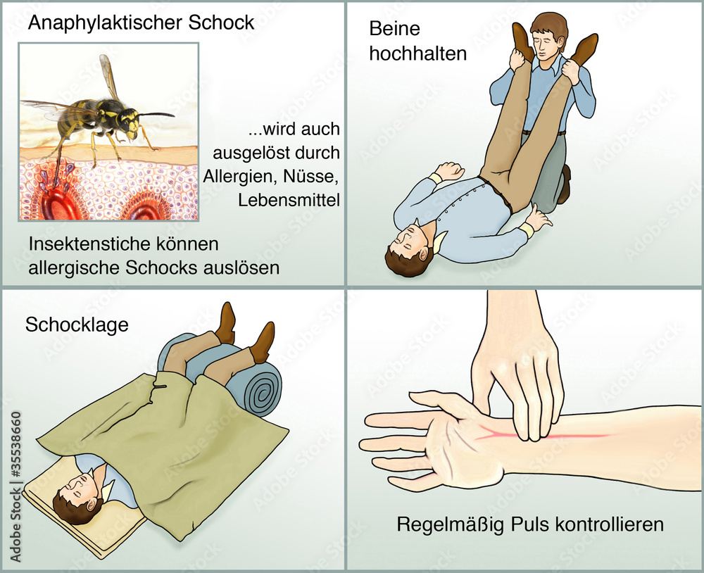 Wie Lange Dauert Es Bis Zum Allergischen Schock Anaphylaktischer Schock.Erste Hilfe Stock-Illustration | Adobe Stock
