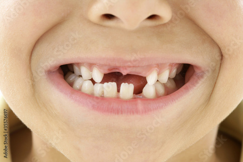 Enfant - Perte des dents de lait photo