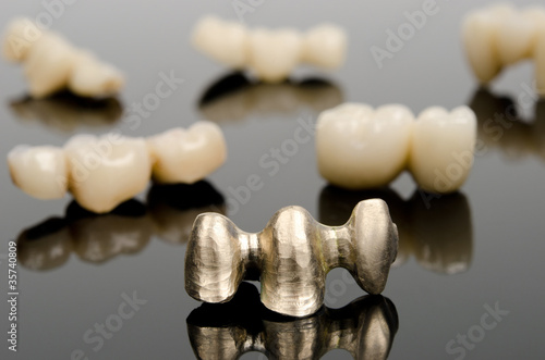 Goldbrücke, Hintergrund verblendete Brücken, Zahntechnik