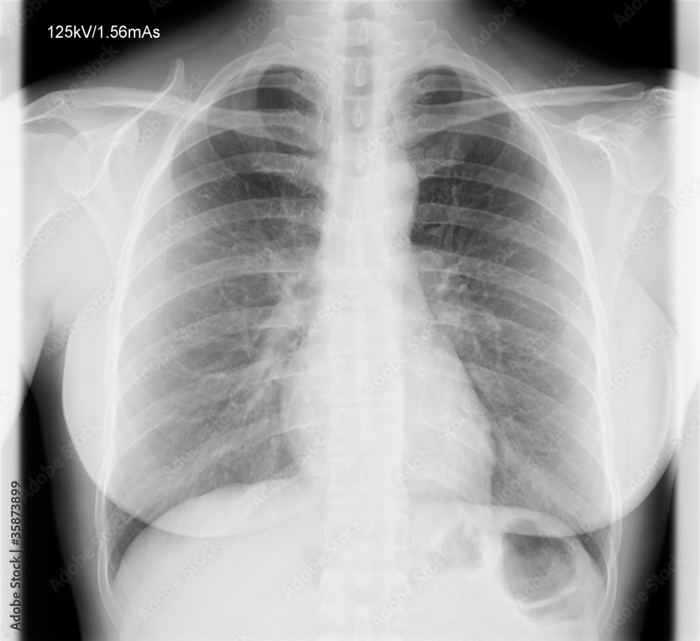 A chest x-ray image for a medical diagnosis. A chest x-ray image for a medical diagnosis.