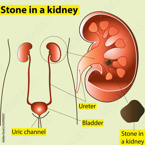 Stone in the kidney