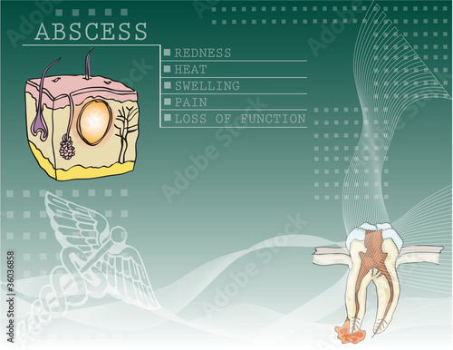 Background Abscess