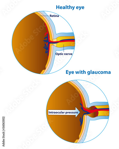 Glaucoma