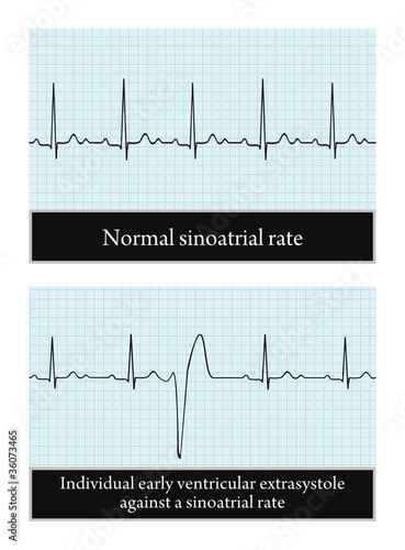 Electrocardiogram. Normal and pathological. Detailed vector.