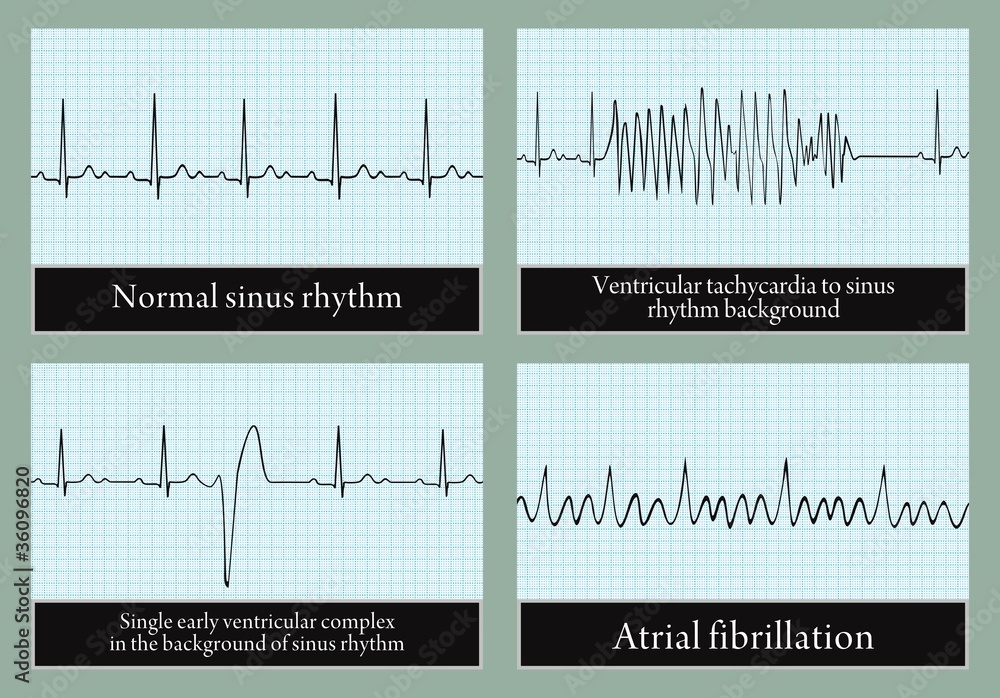 Examples of normal and abnormal ECG. Vector.