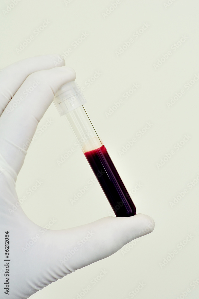 Blood sample Blood sample