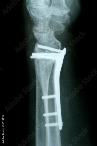 Frakturversorgung mit winkelstabiler Platte