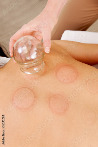 Red Fire Cupping Marks