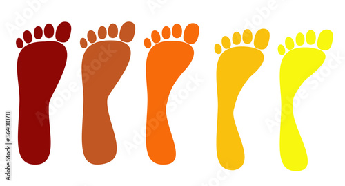 flat feet, various stages of the disease