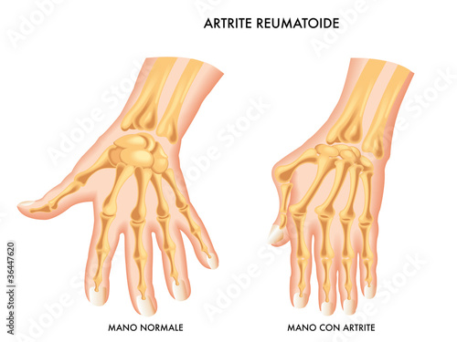 Artrite Reumatoide