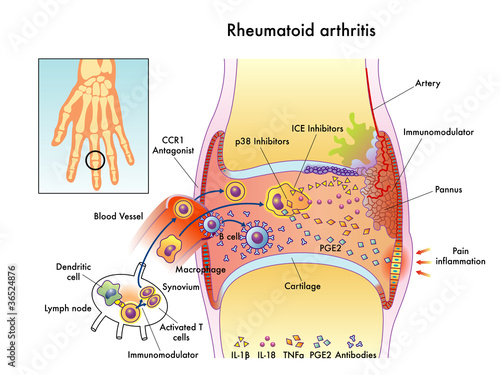 Artrite Reumatoide