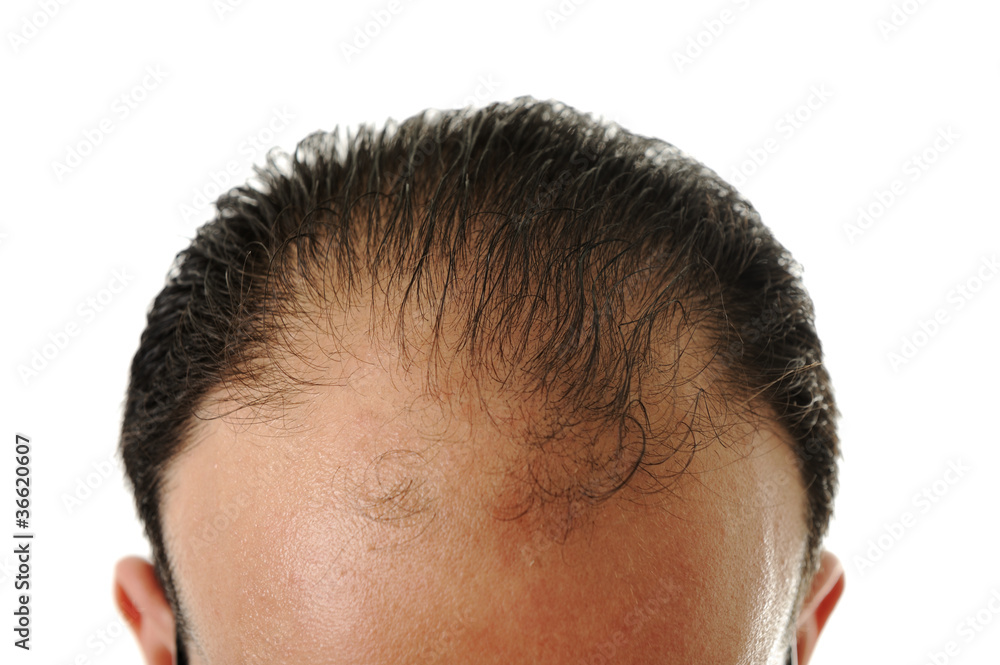 Obraz premium Man loosing hair, baldness