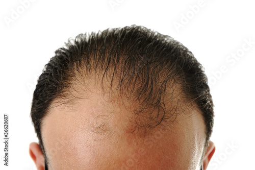 Canvas-taulu Man loosing hair, baldness