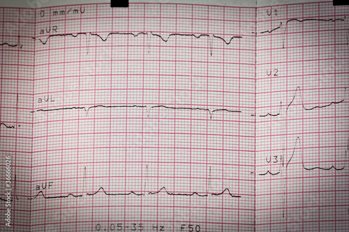 Electrocardiogram Result