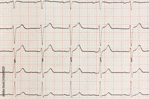 Electrocardiogram Result