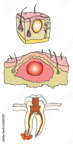 Abscess