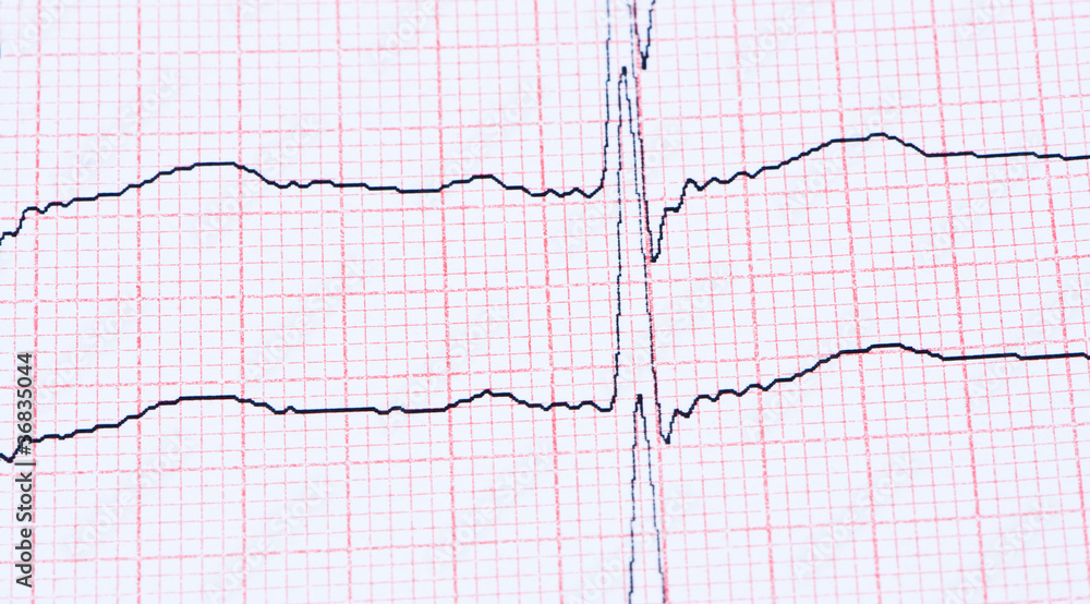 Cardiogram on paper. Cardiogram on paper.