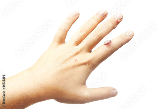 hand with warts isolated on white background
