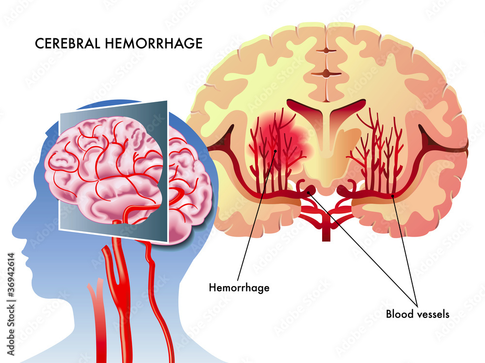 Vettoriale Stock Emorragia cerebrale Adobe Stock