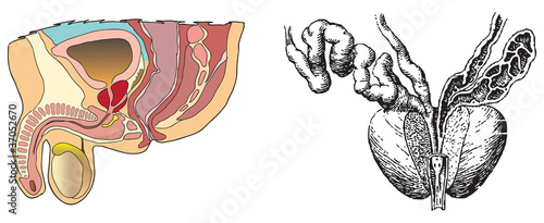 Prostatitis is an illustration