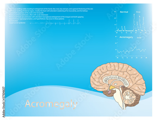 Acromegaly